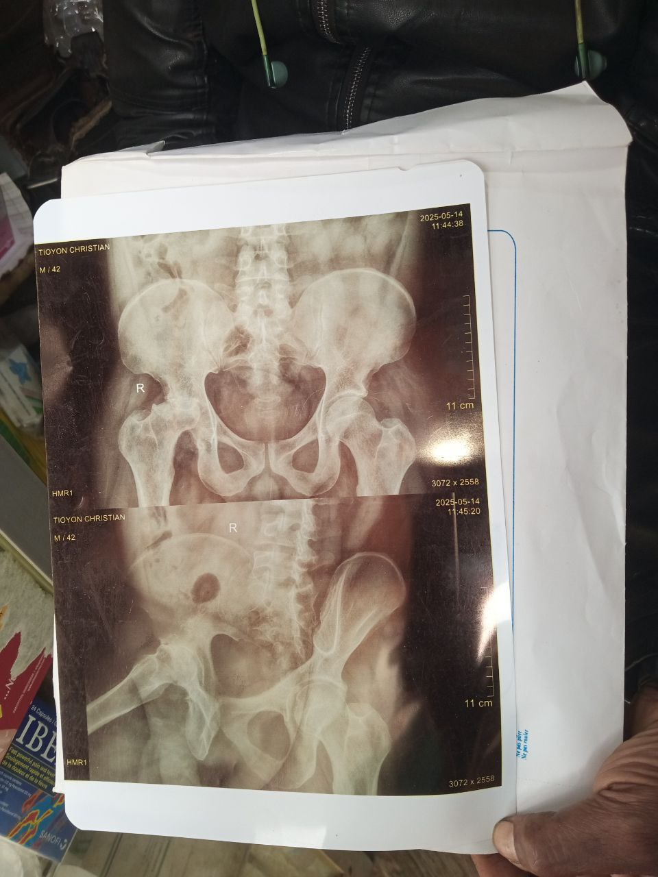 Causes du mal de dos — conseils kinésithérapeute Cameroun